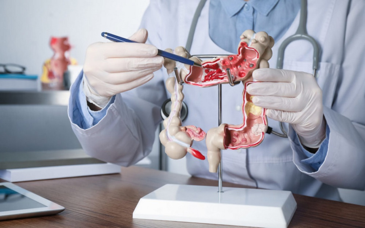 imagen Estudian un tratamiento que bloquea el crecimiento del cáncer colorrectal en estadios avanzados